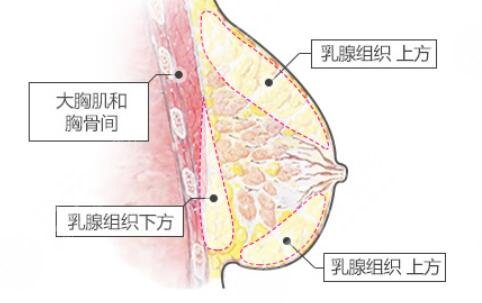 自体脂肪隆胸果好不好