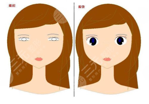 10个开内眼角9个留疤怎么办