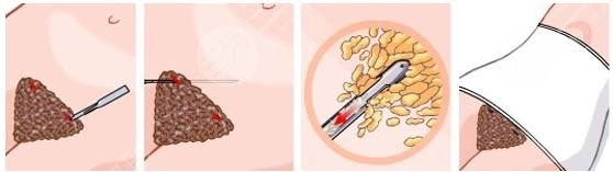 抽脂手术副作用避雷指南(注意事项)