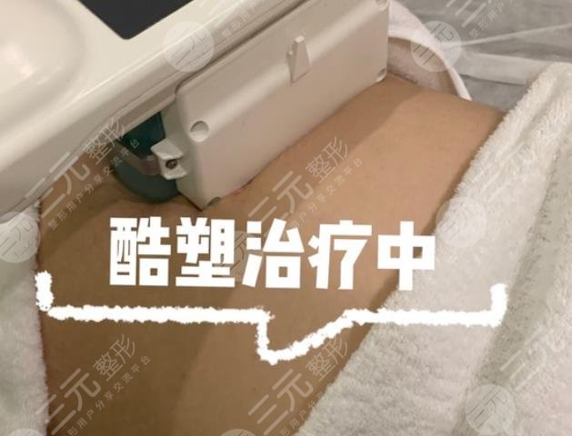 酷塑冷冻减脂