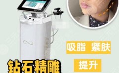 钻石吸脂术怎么样?核心原理解析,还你不一样的自己 钻石吸脂术怎么样?核心原理解析,还你不一样的自己