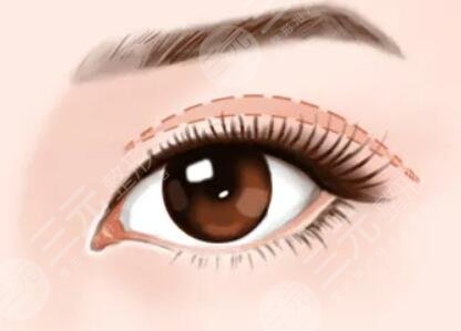 微创双眼皮的果好不好