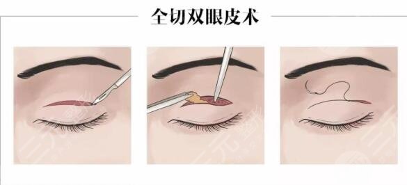 全切双眼皮手术是怎么做的