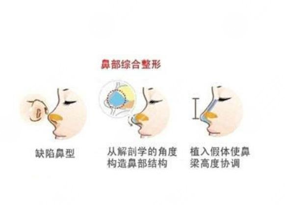 鼻部手术整形有缺点吗?