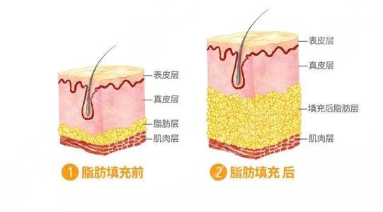 填充额头多少钱？玻尿酸or自体脂肪？一文详解丰额头的秘籍，马住！