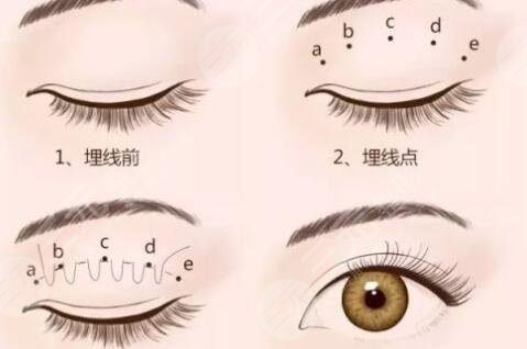 微创双眼皮技术果怎么样
