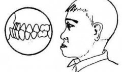 地包天矫正前后对比图文讲解！正颌or正畸？手术不可盲目选择！