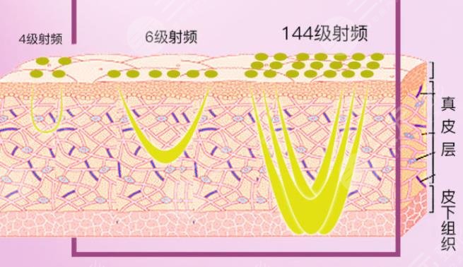 热玛吉