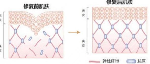 热玛吉