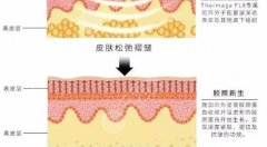 热玛吉的功作用及副作用科普!原理透彻分析,正确认识抗衰~ 热玛吉的功作用及副作用科普!原理透彻分析,正确认识抗衰~