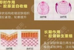 热玛吉新一代多少钱？FLX原理&术后事项科普！这价格值得掏钱吗？