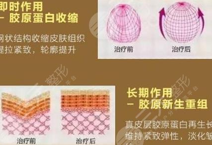 热玛吉