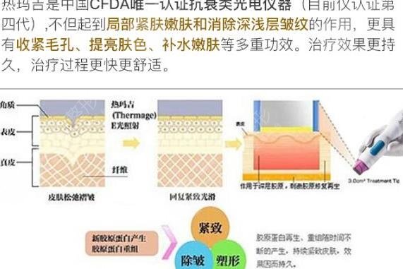热玛吉
