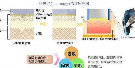 热玛吉