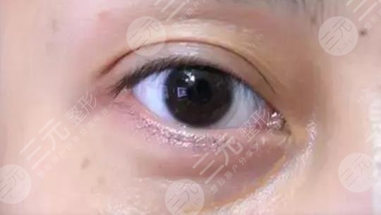 嗨体填充泪沟
