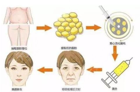 天津公安医院整形科面部脂肪填充