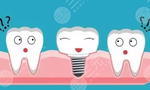 种植牙全程需要几个月?种植牙的优势分析&注意事项