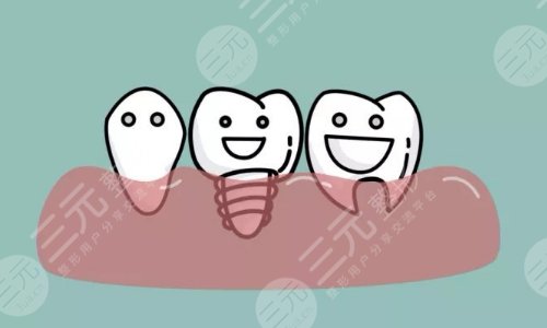 种植牙全程需要几个月