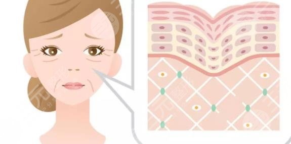 超声提拉去法令纹果怎么样