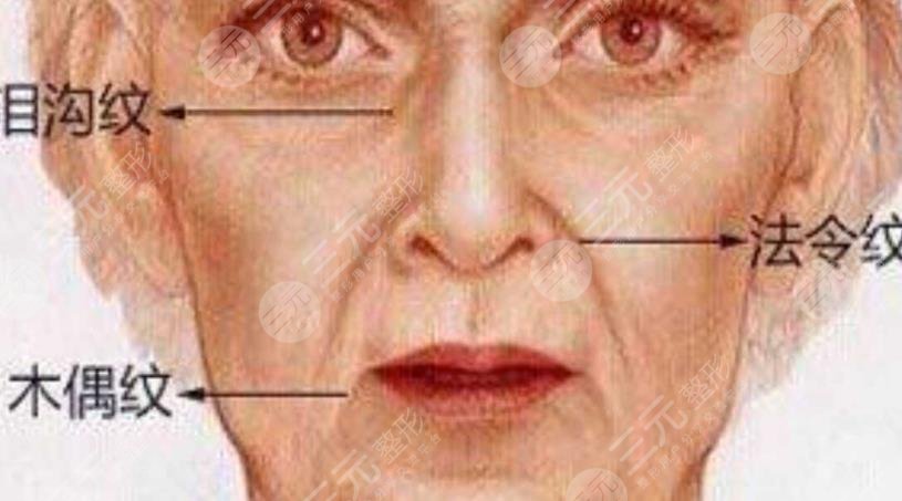 超声提拉去法令纹果怎么样