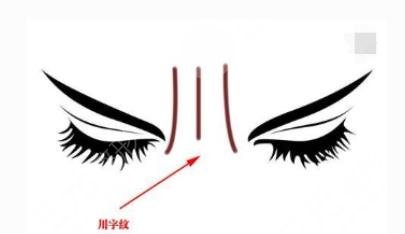 玻尿酸填充川字纹