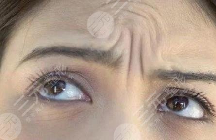 玻尿酸填充川字纹