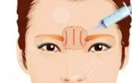 玻尿酸填充川字纹