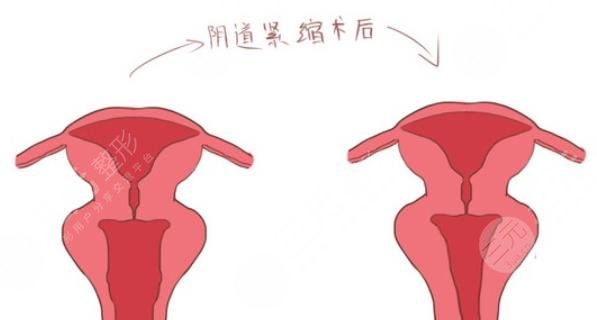 私密紧缩