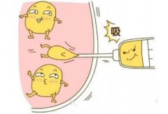 吸脂：优点、原理、可靠性等6大问题详细科普！肥宅必备塑身秘法！