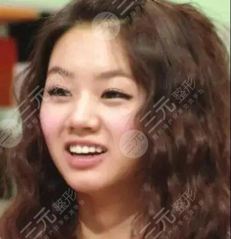 但像李惠利这类上眼睑皮下组织过度丰富,且眉眼距宽的人,埋线双眼皮果