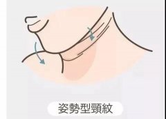颈纹:成熟女人的劲敌!怎么消除?本篇攻略建议全文背诵! 颈纹:成熟女人的劲敌!怎么消除?本篇攻略建议全文背诵!