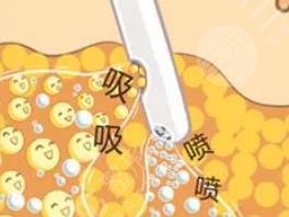 光雕吸脂