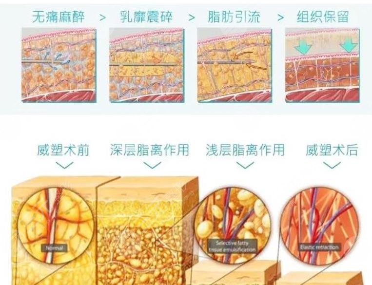 威塑吸脂