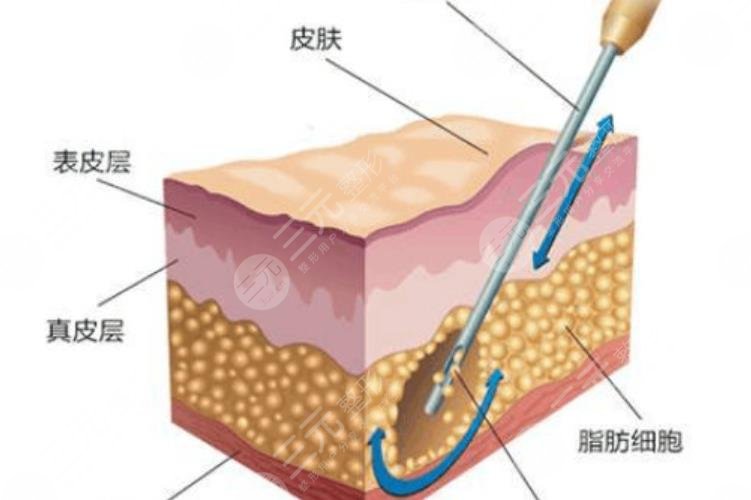 水动力吸脂