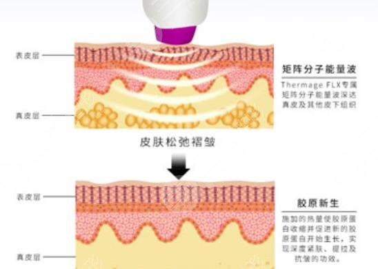 五代热玛吉