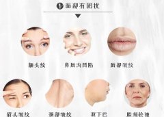 热玛吉有什么果和副作用?明星抗衰项目也并非**无缺!科普分享~ 热玛吉有什么果和副作用?明星抗衰项目也并非**无缺!科普分享~