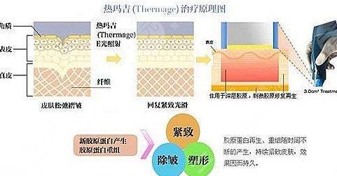 热玛吉