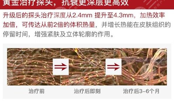 热玛吉