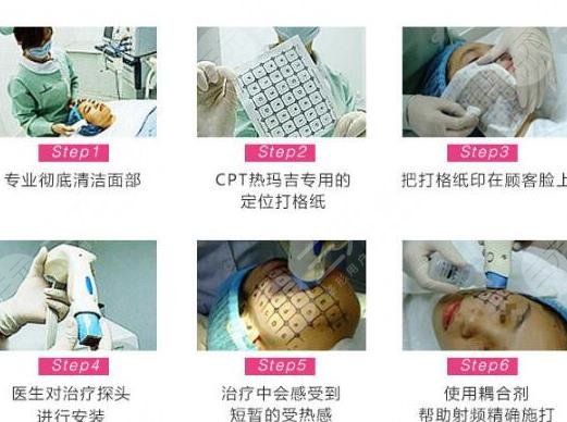 热玛吉