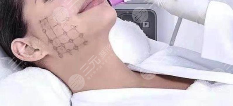 热玛吉除皱
