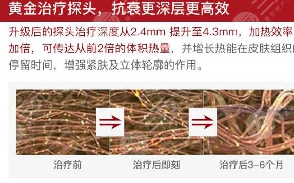热玛吉