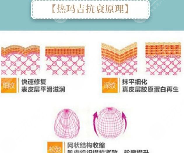 热玛吉