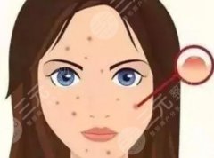 激光祛痘恢复时间多长？2022战痘指南！价格&注意事项保姆级讲解！