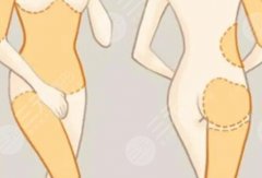 钻石和5G天使光雕哪种好？区别讲解，吸脂纤体不踩雷指南！