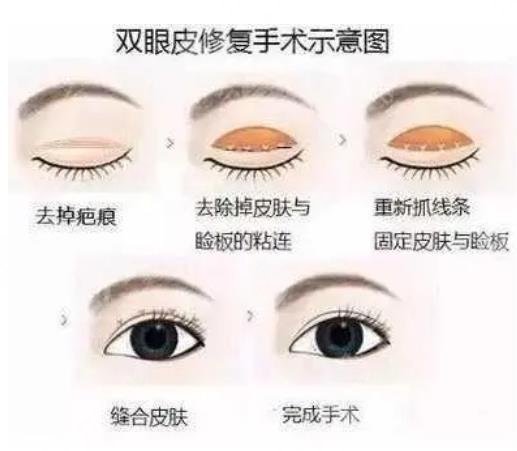 天津双眼皮失败修复价格多少钱?价格受什么因素影响?
