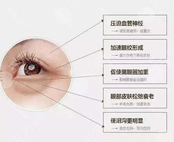 去眼袋降低风险有的方法|动手术好还是微创好?1分钟了解~