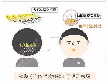 天津总医院微创植发案例：解决秃额头的困扰