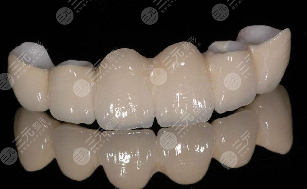 烤瓷牙多少钱一颗价格表2022预览！分析原理&注意事项，助你更好挑选！