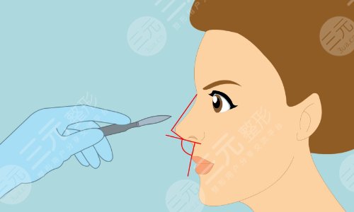 眼部整形失败修复手术之后的事项