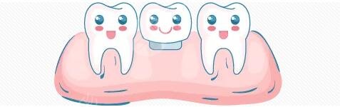 牙齿种植手术原理